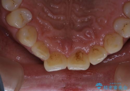 毎日コーヒーを飲む 歯を白くしたいの治療前