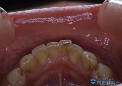 毎日コーヒーを飲む 歯を白くしたいの治療前