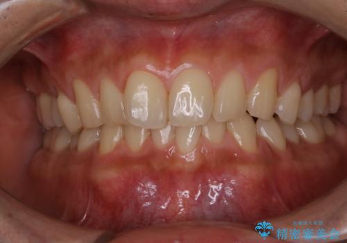 毎日コーヒーを飲む 歯を白くしたいの治療後