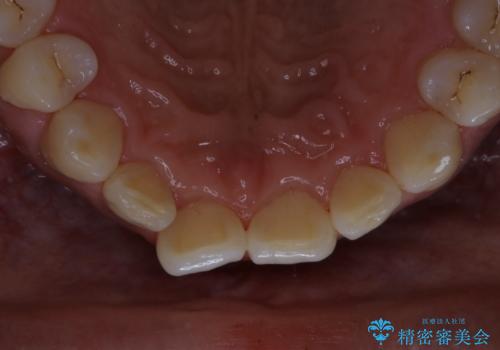 毎日コーヒーを飲む 歯を白くしたいの治療後