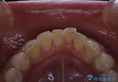 毎日コーヒーを飲む 歯を白くしたいの治療後