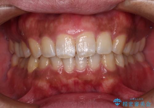 インビザラインによる矯正治療と、折れてしまった歯のインプラント補綴治療の治療後