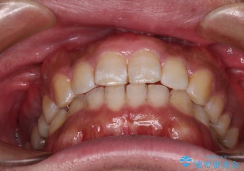 インビザラインによる矯正治療と、折れてしまった歯のインプラント補綴治療の治療後