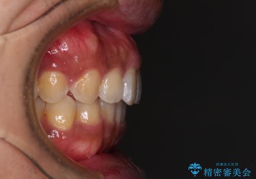 インビザラインによる矯正治療と、折れてしまった歯のインプラント補綴治療の治療後