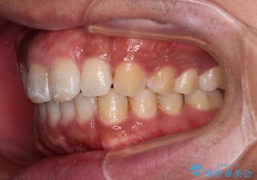 インビザラインによる矯正治療と、折れてしまった歯のインプラント補綴治療の治療後