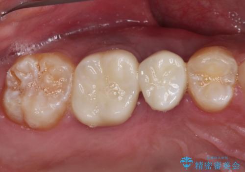 インビザラインによる矯正治療と、折れてしまった歯のインプラント補綴治療の治療後