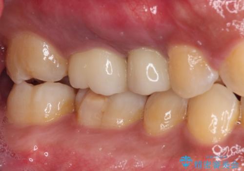 インビザラインによる矯正治療と、折れてしまった歯のインプラント補綴治療の治療後