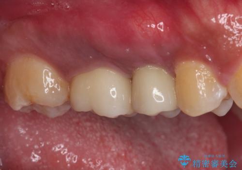 インビザラインによる矯正治療と、折れてしまった歯のインプラント補綴治療の治療後