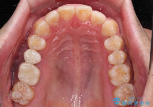 インビザラインによる矯正治療と、折れてしまった歯のインプラント補綴治療の治療後