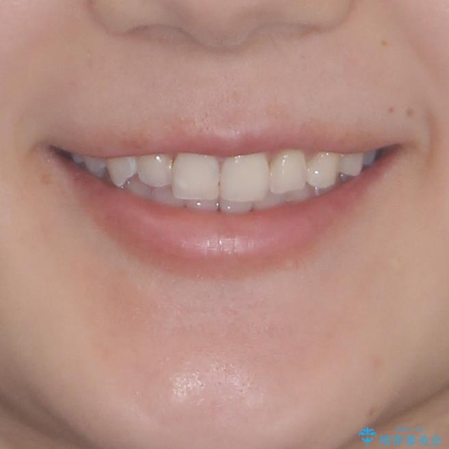 インビザライン単独では困難 補助装置を併用した矯正治療の治療後(顔貌)