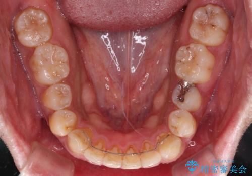 インビザラインによる矯正治療と、折れてしまった歯のインプラント補綴治療の治療後