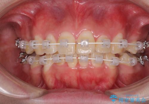 前歯の出っ歯と口の閉じにくさを抜歯矯正で改善 目立たないワイヤー矯正の治療中