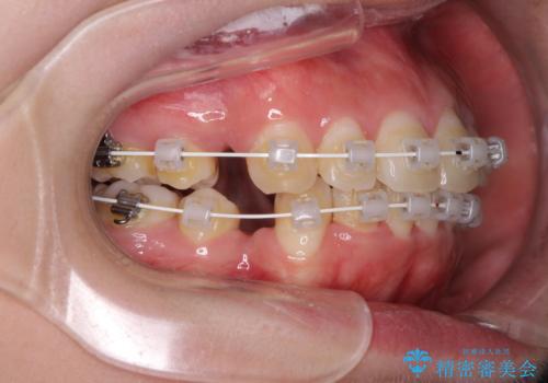 前歯の出っ歯と口の閉じにくさを抜歯矯正で改善 目立たないワイヤー矯正の治療中