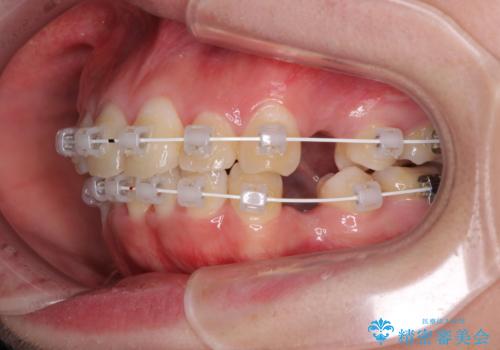前歯の出っ歯と口の閉じにくさを抜歯矯正で改善　目立たないワイヤー矯正の治療中