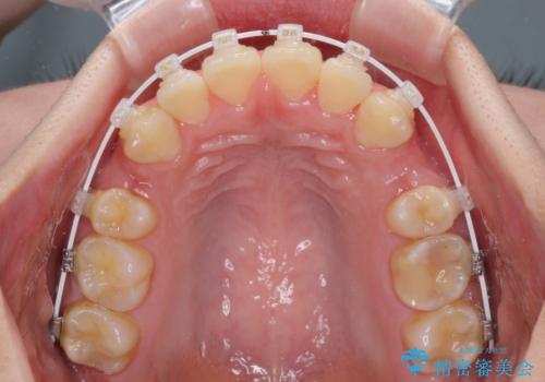 前歯の出っ歯と口の閉じにくさを抜歯矯正で改善 目立たないワイヤー矯正の治療中