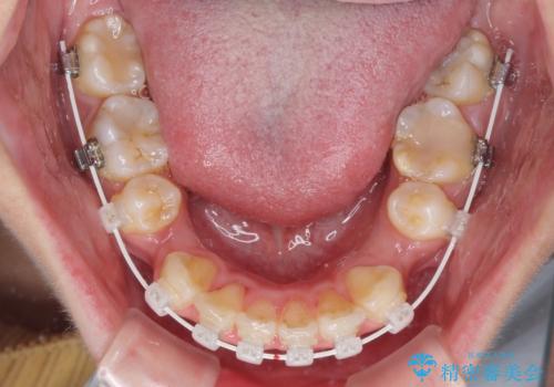 前歯の出っ歯と口の閉じにくさを抜歯矯正で改善 目立たないワイヤー矯正の治療中