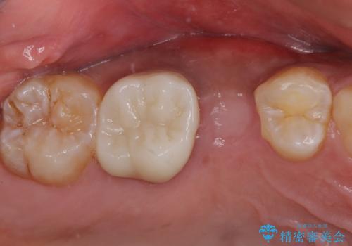 インビザラインによる矯正治療と、折れてしまった歯のインプラント補綴治療の治療中