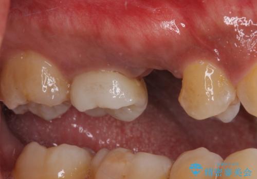 インビザラインによる矯正治療と、折れてしまった歯のインプラント補綴治療の治療中