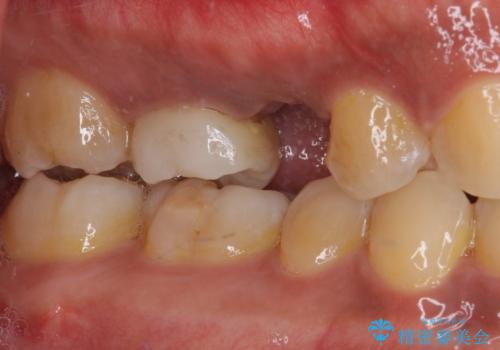 インビザラインによる矯正治療と、折れてしまった歯のインプラント補綴治療の治療中