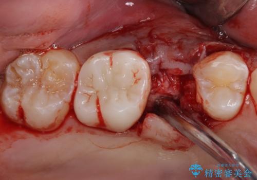 インビザラインによる矯正治療と、折れてしまった歯のインプラント補綴治療の治療前