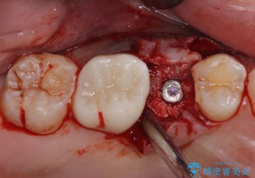 インビザラインによる矯正治療と、折れてしまった歯のインプラント補綴治療の治療中
