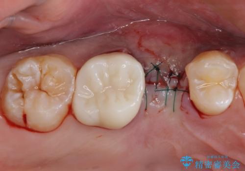 インビザラインによる矯正治療と、折れてしまった歯のインプラント補綴治療の治療後