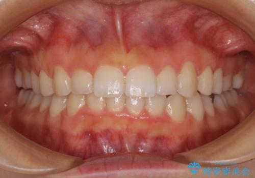 前歯のデコボコと突出感 インビザラインによる矯正治療の症例 治療後