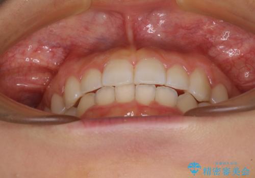 前歯のデコボコと突出感 インビザラインによる矯正治療の治療後