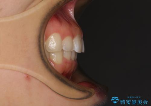 前歯のデコボコと突出感 インビザラインによる矯正治療の治療後