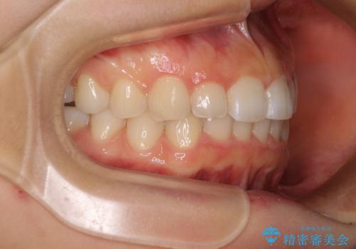 前歯のデコボコと突出感 インビザラインによる矯正治療の治療後