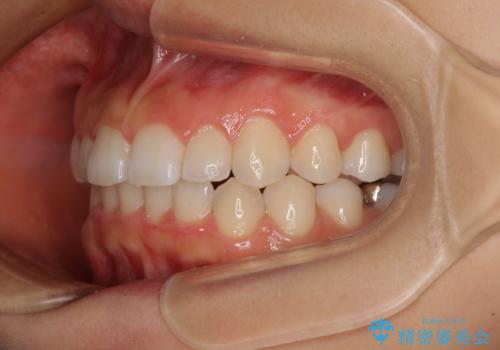 前歯のデコボコと突出感 インビザラインによる矯正治療の治療後