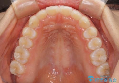 前歯のデコボコと突出感 インビザラインによる矯正治療の治療後