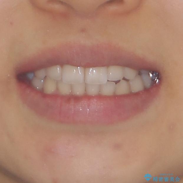 前歯のデコボコと突出感　インビザラインによる矯正治療の治療後（顔貌）