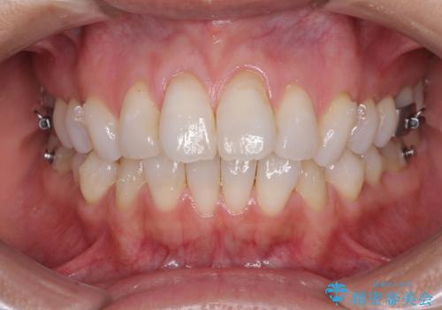 少しだけ飛び出た前歯を整えたい インビザラインによる矯正治療の治療中