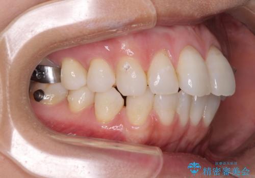 少しだけ飛び出た前歯を整えたい インビザラインによる矯正治療の治療中