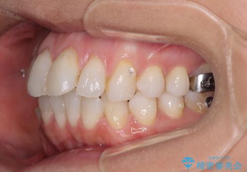 少しだけ飛び出た前歯を整えたい インビザラインによる矯正治療の治療中