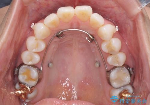 少しだけ飛び出た前歯を整えたい インビザラインによる矯正治療の治療中