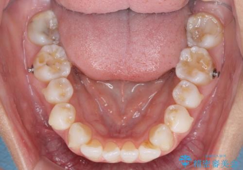 少しだけ飛び出た前歯を整えたい インビザラインによる矯正治療の治療中