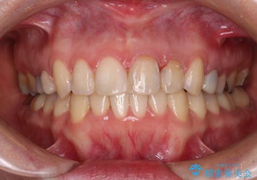 【モニター】前歯のデコボコと奥歯の虫歯　インビザライン治療と奥歯のセラミック治療