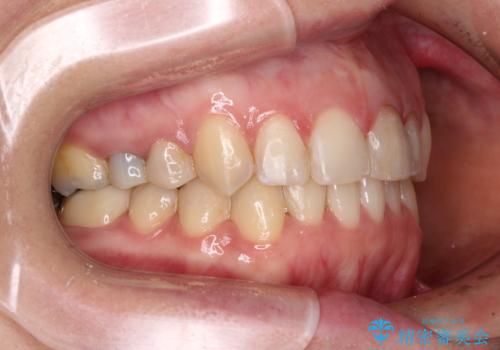 【モニター】前歯のデコボコと奥歯の虫歯　インビザライン治療と奥歯のセラミック治療の治療後