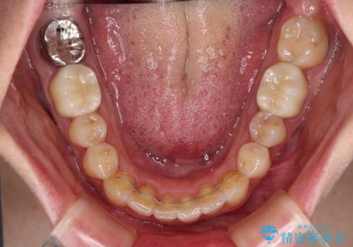 【モニター】前歯のデコボコと奥歯の虫歯　インビザライン治療と奥歯のセラミック治療の治療後