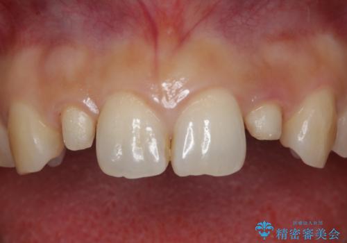 矮小歯を綺麗な歯に。矯正とセラミックの総合治療の治療中