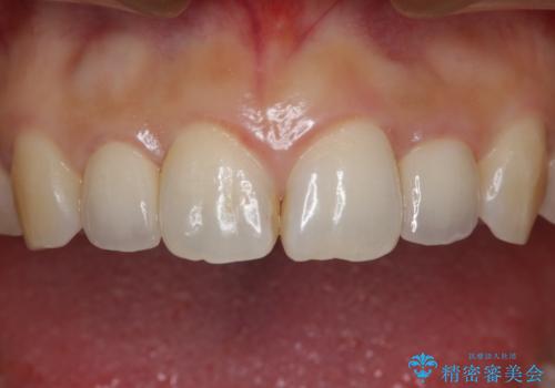 矮小歯を綺麗な歯に。矯正とセラミックの総合治療の治療後