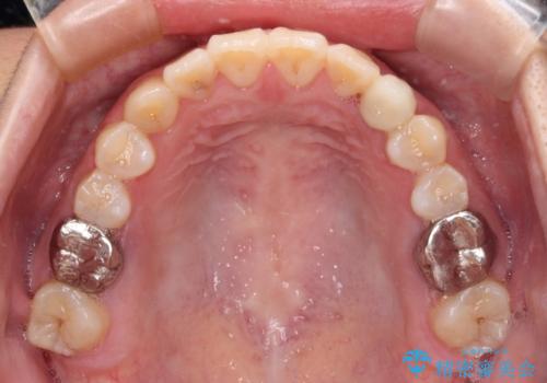 受け口で開咬を急速拡大装置とインビザラインで改善　欠損部分はインプラントにて補綴治療の治療後