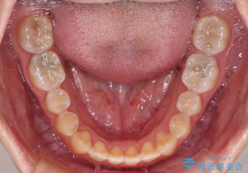 受け口で開咬を急速拡大装置とインビザラインで改善　欠損部分はインプラントにて補綴治療の治療後