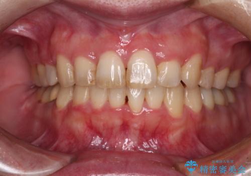 目立つ銀歯を白くしたい 奥歯のセラミック治療の症例 治療後