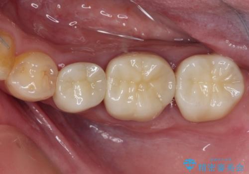 目立つ銀歯を白くしたい　奥歯のセラミック治療