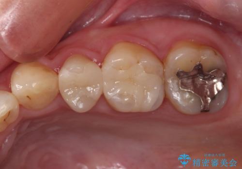 目立つ銀歯を白くしたい 奥歯のセラミック治療の治療後