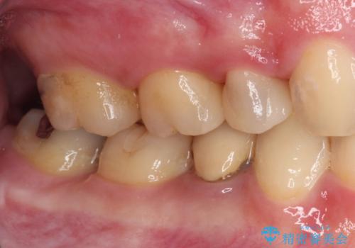 目立つ銀歯を白くしたい 奥歯のセラミック治療の治療後