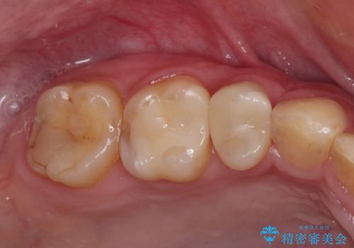 目立つ銀歯を白くしたい 奥歯のセラミック治療の治療後